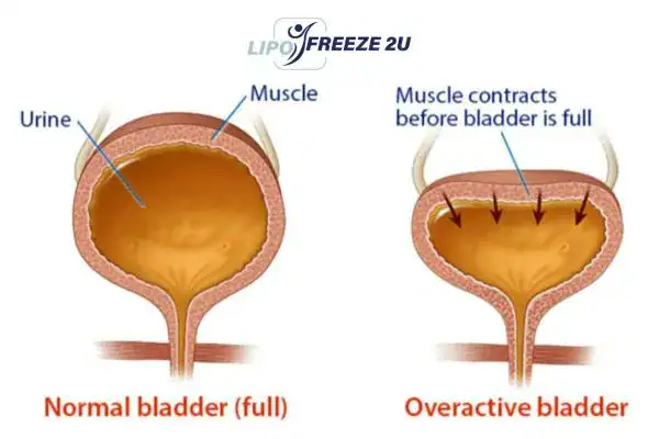 diagram of overactive bladder treatment Ashford