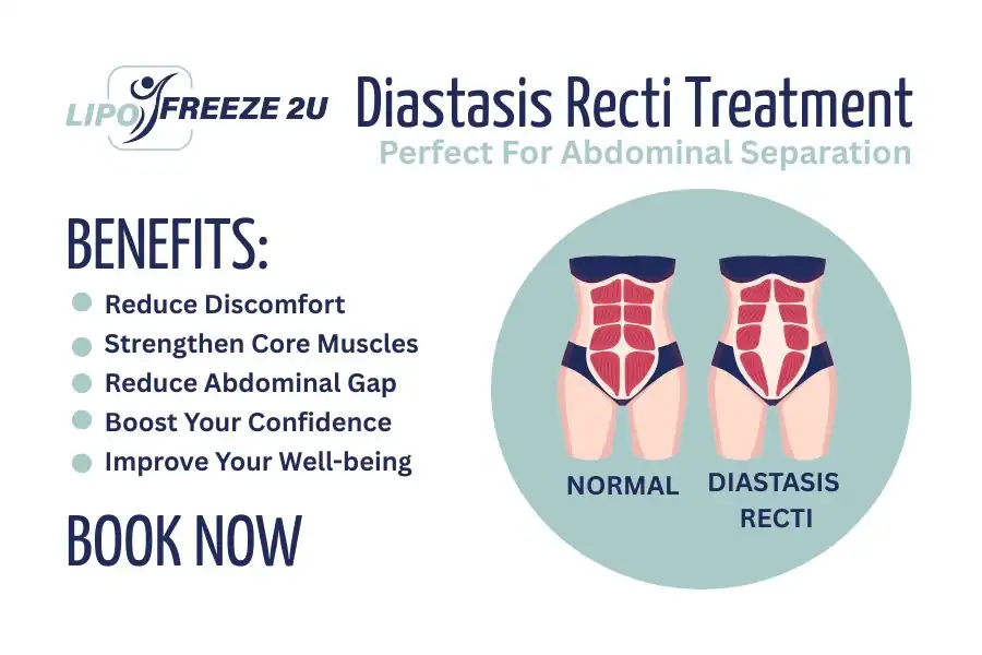 How Long Will It Take to See Improvements in Diastasis Recti Ashford