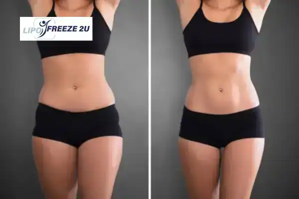 How Can LIPO FREEZE 2U Support Your Post-Pregnancy Body Recovery Ashford?