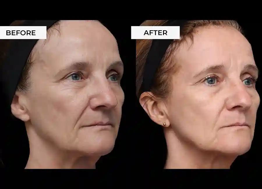 How Many RF Microneedling Sessions Will You Need to See a Difference Ashford?