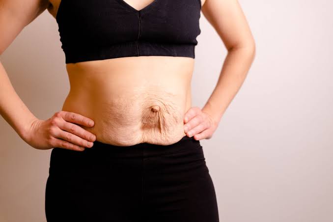 Is Surgery Really the Only Way to Repair Diastasis Recti Ashford?