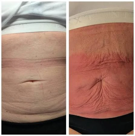 How Does RF Microneedling Improve Crepey, Thin and Uneven Skin Texture Ashford?
