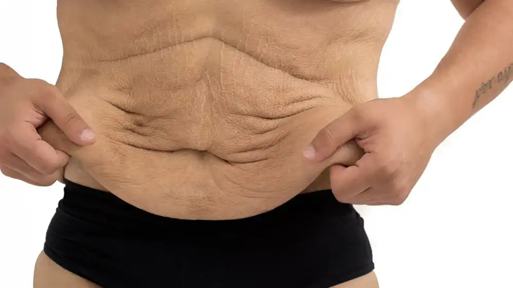 RF Microneedling for Loose Skin: How Can It Help Tighten and Reshape the Skin Ashford?